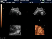 Vivian Sonograms